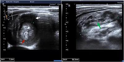 Case Report: Acute intussusception in a 2-year-old male patient: a rare case of Burkitt's lymphoma coexisting with Meckel's diverticulum